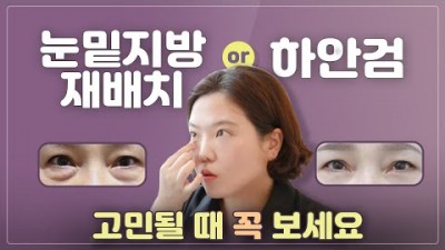 하안검 수술, 눈밑지방재배치, 가격, 중년 눈밑성형, 부작용, 후기, 하안검 눈밑지방재배치 설명